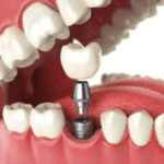 4 Benefits Of Choosing Implants Through A Family Dental Office