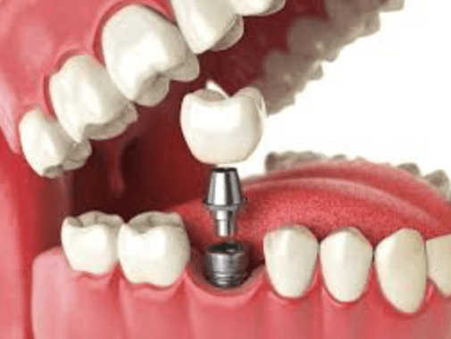 4 Benefits Of Choosing Implants Through A Family Dental Office