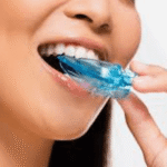 How Custom Mouthguards Support Both Dental Safety And Aesthetics