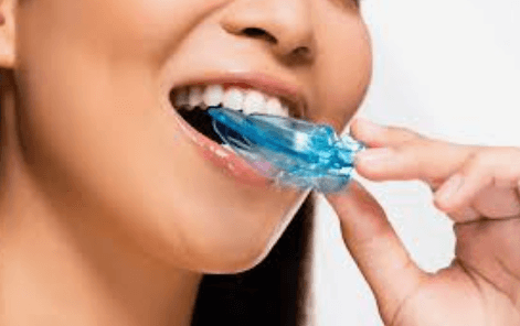 How Custom Mouthguards Support Both Dental Safety And Aesthetics