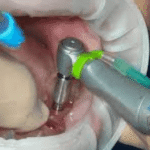 How Implant Dentists Work Alongside General Dentists For Best Results