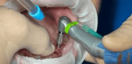 How Implant Dentists Work Alongside General Dentists For Best Results