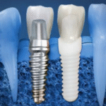 Dental Implant Materials: Titanium Vs. Zirconia And What To Consider