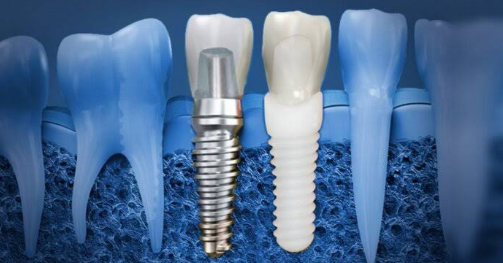 Dental Implant Materials: Titanium Vs. Zirconia And What To Consider