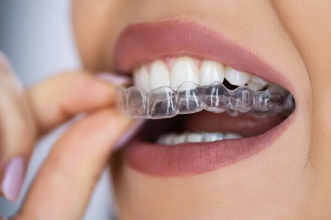 4 Benefits Of Choosing Clear Aligners Over Traditional Braces