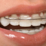 The Importance Of Retainers After Orthodontic Work