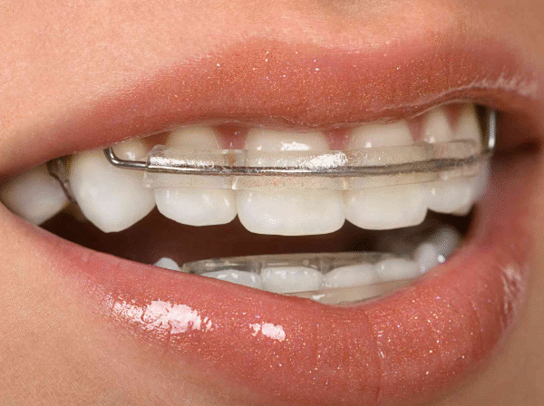 The Importance Of Retainers After Orthodontic Work
