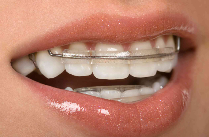 The Importance Of Retainers After Orthodontic Work