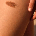 What Is Neurofibromatosis? Understanding This Genetic Condition