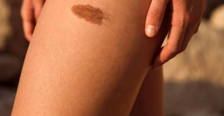 What Is Neurofibromatosis? Understanding This Genetic Condition