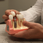 4 Reasons Periodontal Treatment Improves Implant Success