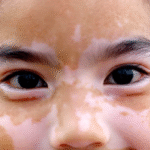 Understanding the Possible Reasons Behind White Facial Patches in Children