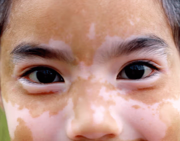 Understanding the Possible Reasons Behind White Facial Patches in Children