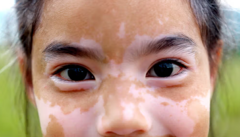 Understanding the Possible Reasons Behind White Facial Patches in Children