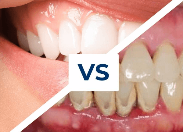 3 Signs You May Need Periodontal Treatment Before Implants
