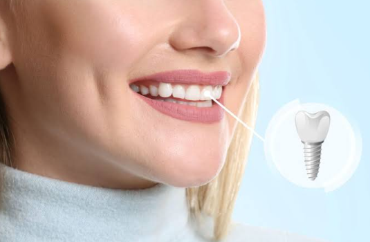How Implant And Cosmetic Dentists Rebuild A Smile After Front Tooth Loss