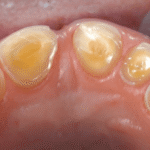 Understanding How Dental Wear Patterns Reveal Stress Levels and Guide Protective Appliance Design