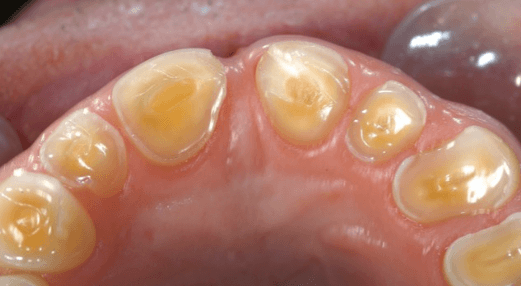 Understanding How Dental Wear Patterns Reveal Stress Levels and Guide Protective Appliance Design